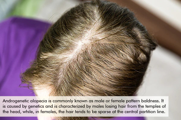 hair loss due to androgenetic alopecia