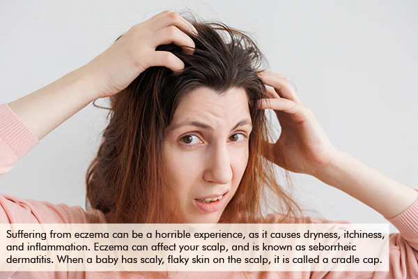 coconut oil can help tackle scalp eczema