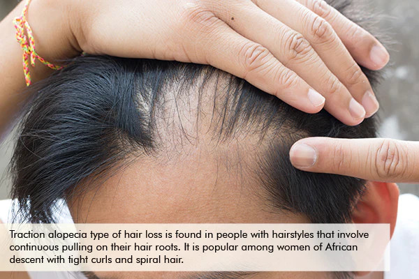 hair loss due to traction alopecia