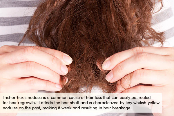 trichorrhexis nodosa hair loss