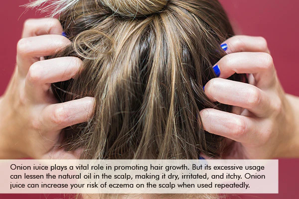 onion juice usage on hair can lead to increased risk of eczema