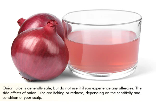 general queries on using onion juice for dandruff