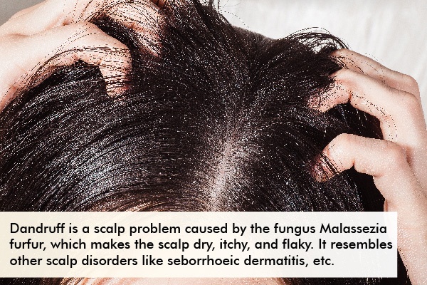 dandruff is a common hair woe that may occur during the monsoons