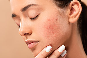 is niacinamide beneficial for oily, acne-prone skin?