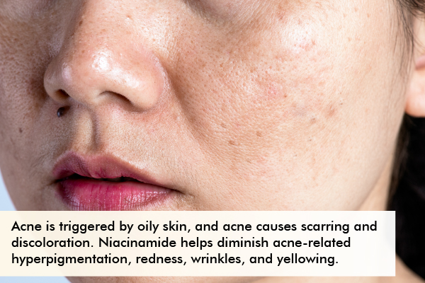 topical usage of niacinamide can help fade hyperpigmentation