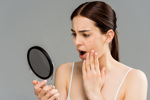 does increased estrogen levels cause acne?