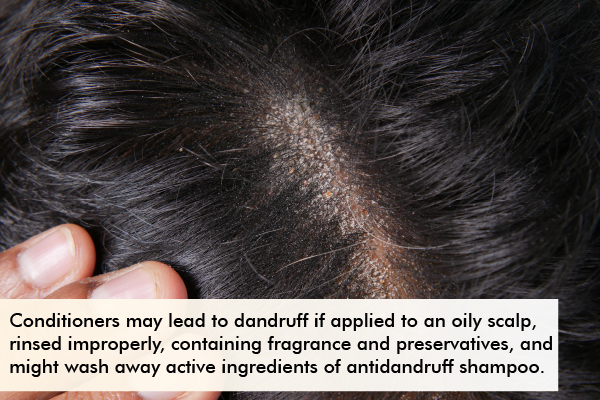 when can using hair conditioner lead to dandruff issues?